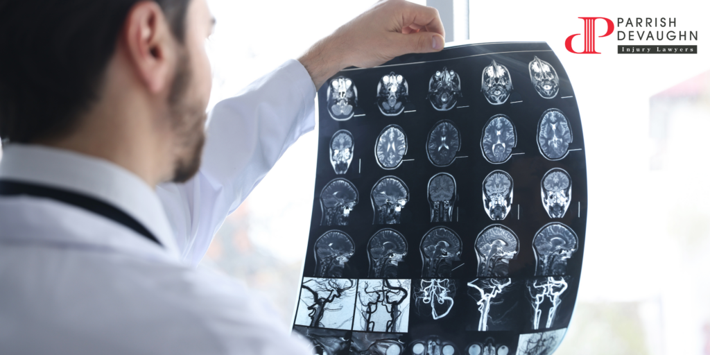 Traumatic Brain Injury Symptoms After a Car Accident – What You Need to Know